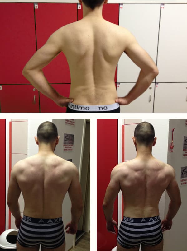 Identity protected (32) - 3D animator - 6 months - Premium package - Muscle weakness, scoliosis, malnutrition..